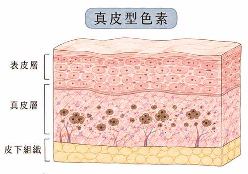 除斑雷射2