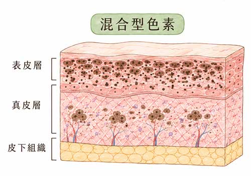 除斑雷射3